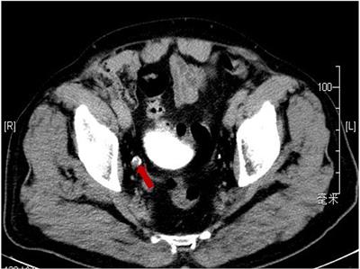 Testicular metastasis from urothelial carcinoma: case report and literature review